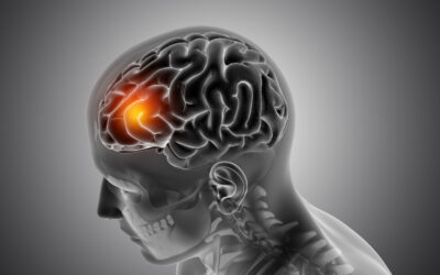¿Cuál es la diferencia entre ictus y derrame cerebral?